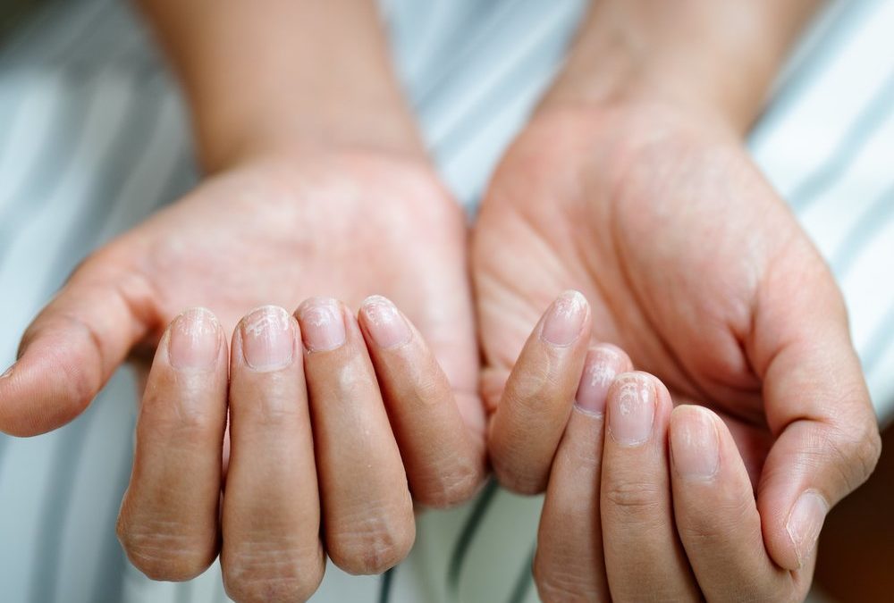 Brüchige Nägel? So stärkt man sie langfristig