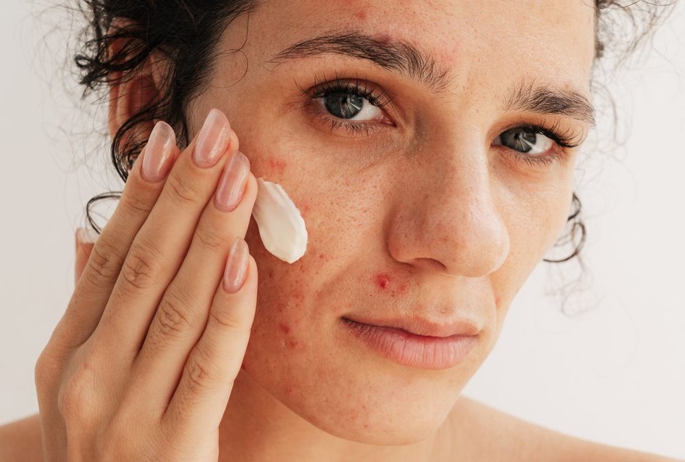 Trendwirkstoff Azelainsäure: Was kann er wirklich?